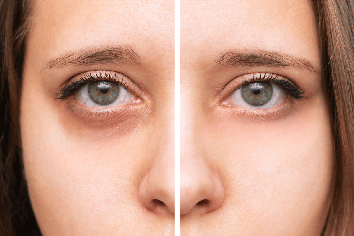 Before and after under-eye filler showing reduced hollowing and shadowing beneath the eyes